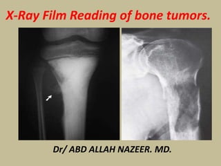 Dr/ ABD ALLAH NAZEER. MD.
X-Ray Film Reading of bone tumors.
 