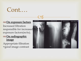 
 On exposure factors
Increased filtration
responsible for increased
exposure factors(mAs).
 On radiographic
image
Appropriate filtration
=good image contrast
Cont.…
 
