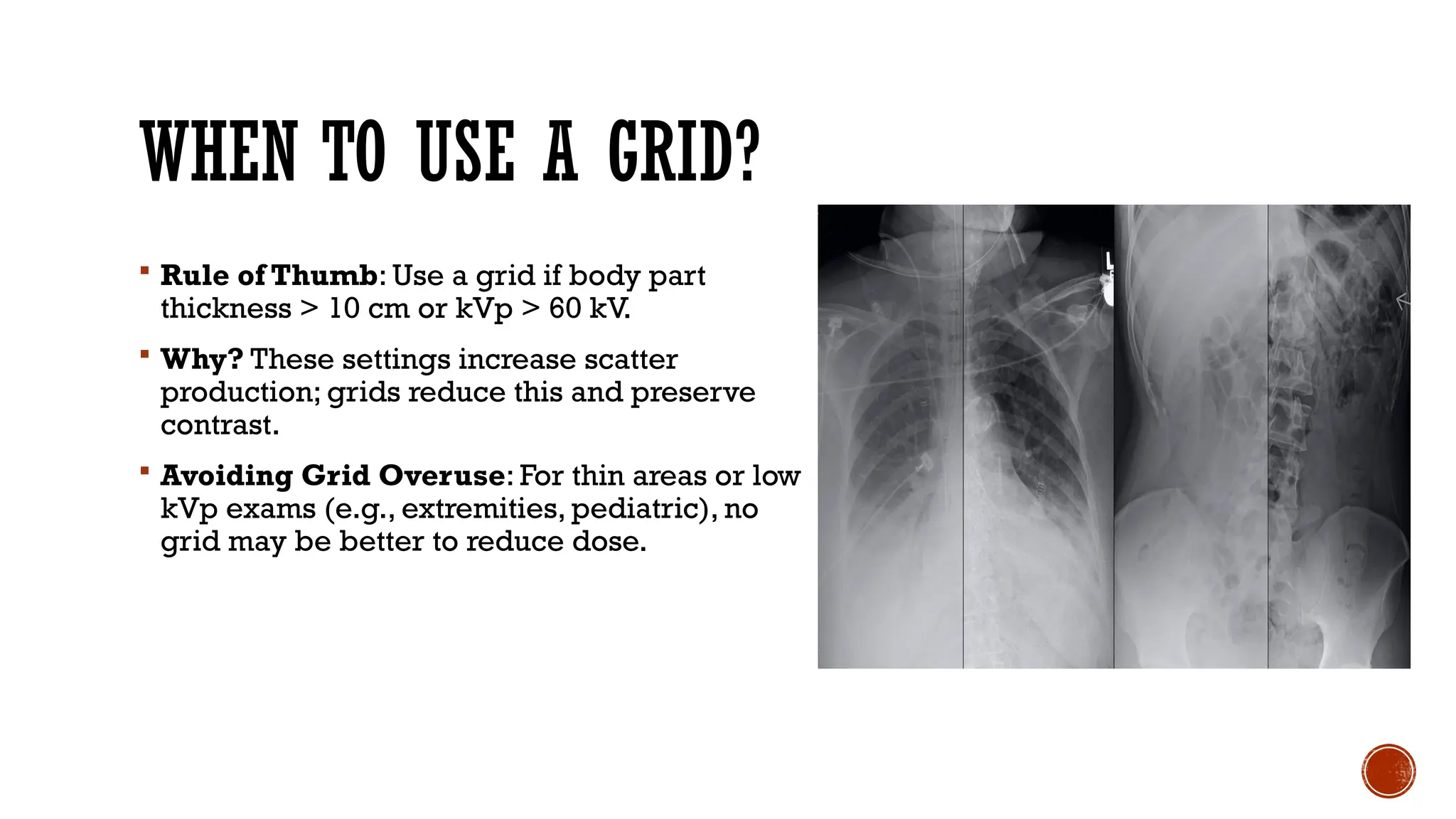 WHEN TO USE A GRID?
 Rule of Thumb: Use a grid if body part
thickness > 10 cm or kVp > 60 kV.
 Why? These settings increase scatter
production; grids reduce this and preserve
contrast.
 Avoiding Grid Overuse: For thin areas or low
kVp exams (e.g., extremities, pediatric), no
grid may be better to reduce dose.
 