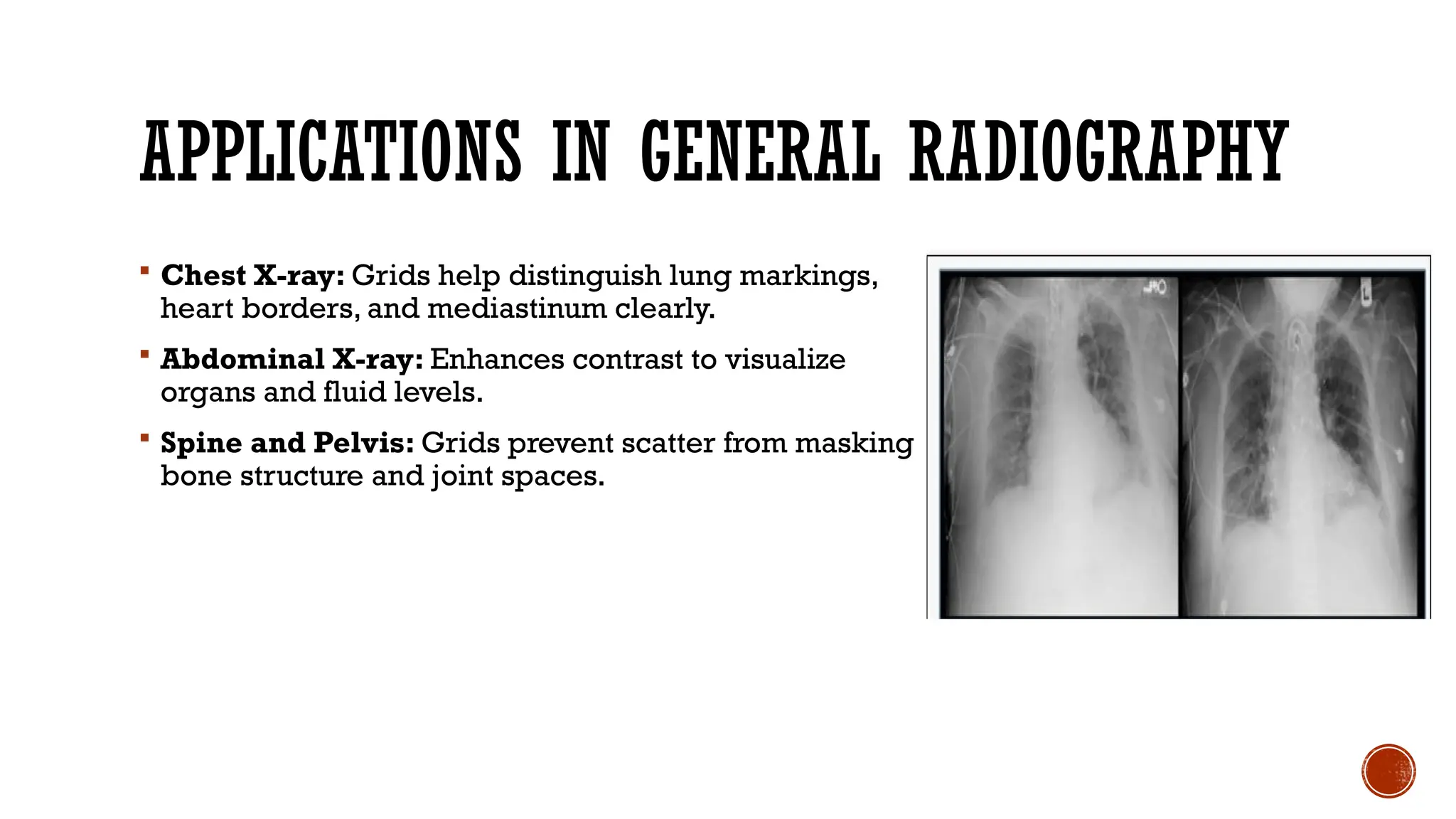 APPLICATIONS IN GENERAL RADIOGRAPHY
 Chest X-ray: Grids help distinguish lung markings,
heart borders, and mediastinum clearly.
 Abdominal X-ray: Enhances contrast to visualize
organs and fluid levels.
 Spine and Pelvis: Grids prevent scatter from masking
bone structure and joint spaces.
 