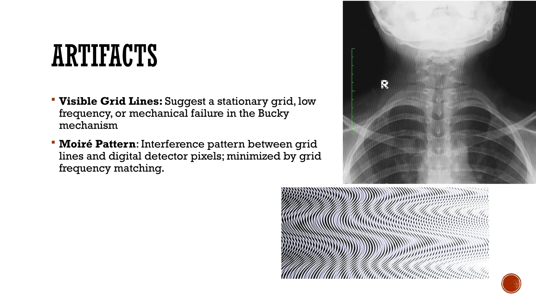 ARTIFACTS
 Visible Grid Lines: Suggest a stationary grid, low
frequency, or mechanical failure in the Bucky
mechanism
 Moiré Pattern: Interference pattern between grid
lines and digital detector pixels; minimized by grid
frequency matching.
 