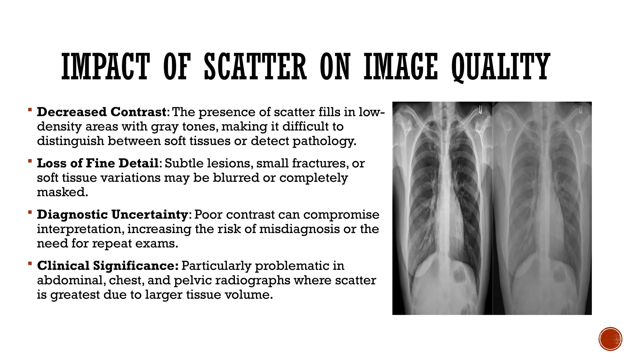 IMPACT OF SCATTER ON IMAGE QUALITY
 Decreased Contrast:The presence of scatter fills in low-
density areas with gray tones, making it difficult to
distinguish between soft tissues or detect pathology.
 Loss of Fine Detail: Subtle lesions, small fractures, or
soft tissue variations may be blurred or completely
masked.
 Diagnostic Uncertainty: Poor contrast can compromise
interpretation, increasing the risk of misdiagnosis or the
need for repeat exams.
 Clinical Significance: Particularly problematic in
abdominal, chest, and pelvic radiographs where scatter
is greatest due to larger tissue volume.
 