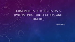 X-RAY IMAGES OF LUNG DISEASES
(PNEUMONIA, TUBERCULOSIS, AND
TUMORS).
M.KURTANIDZE
 