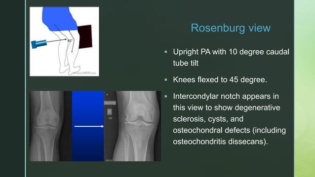 Normal Rosenberg. View X ray knee joint | PPTX