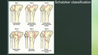 Scthker Classification X ray knee joint | PPTX