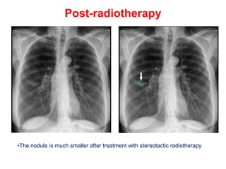 Chest Radiotherapy CHEST X-RAYS OF LUNGCANCER.........pptx