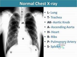 Xray (lungs)