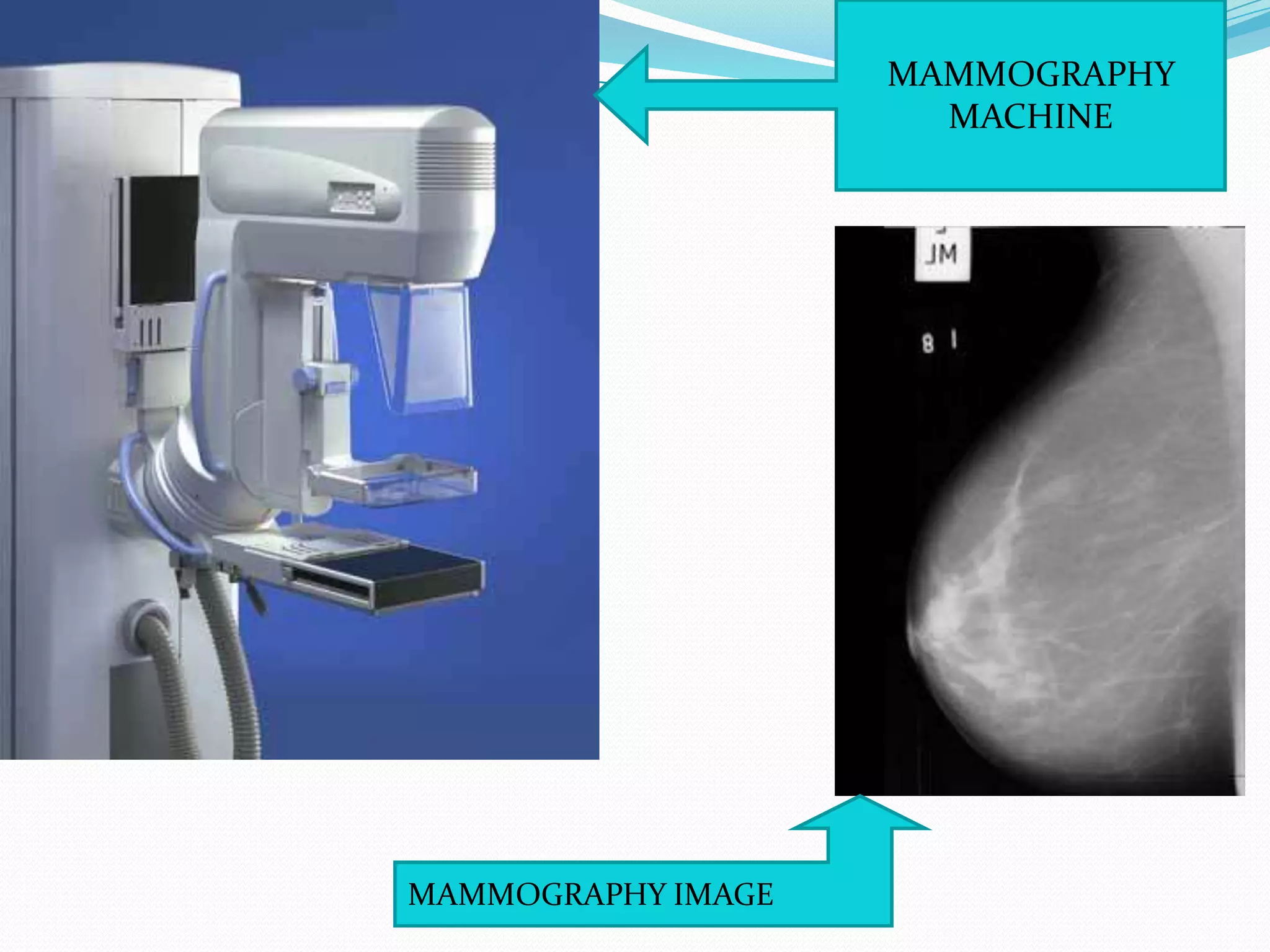 MAMMOGRAPHY
                      MACHINE




MAMMOGRAPHY IMAGE
 