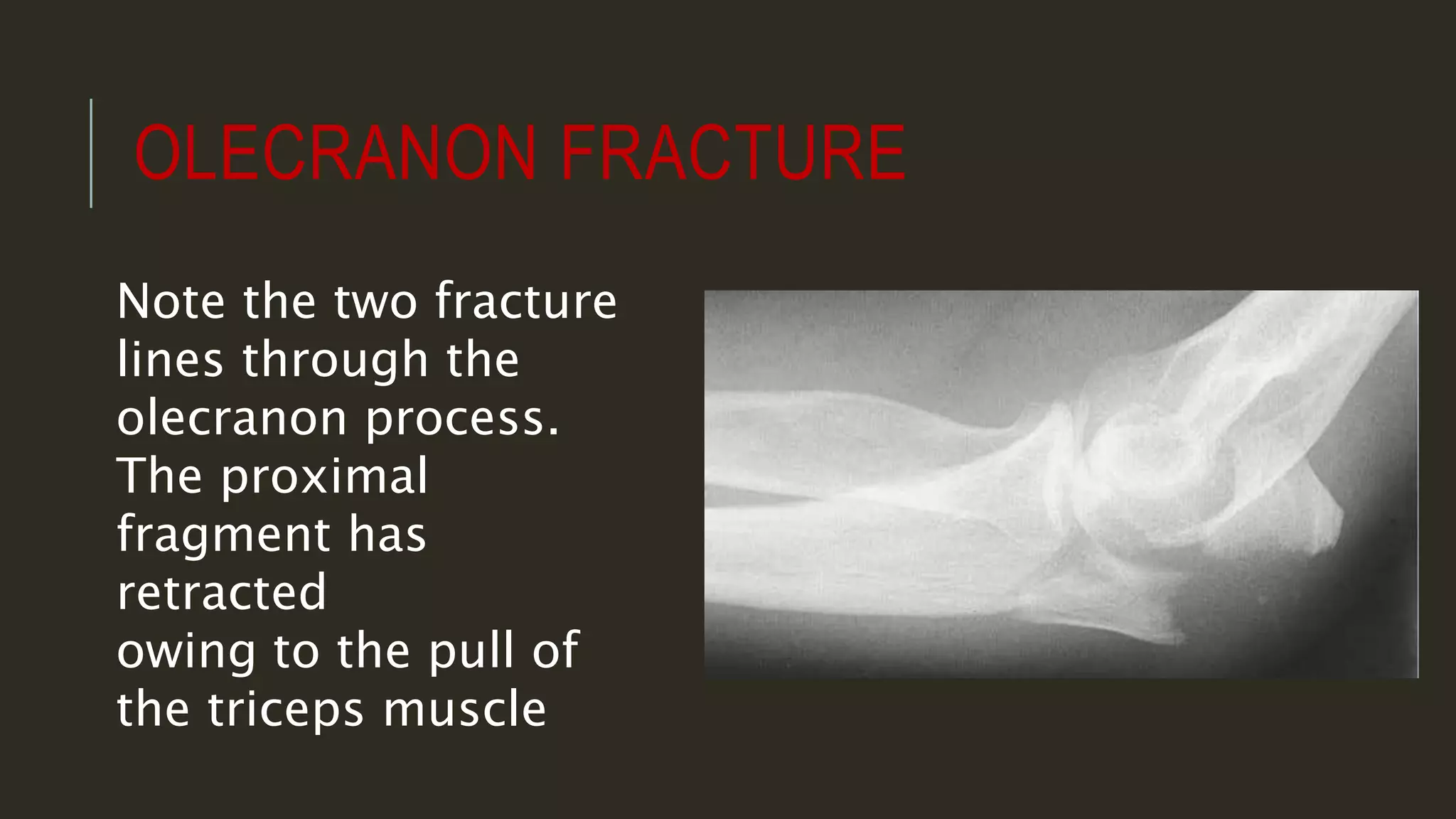 X ray of elbow joint | PPTX