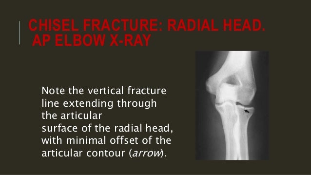 x ray of elbow joint elbow xray