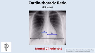 X-RAY OF THE HEART.pptx