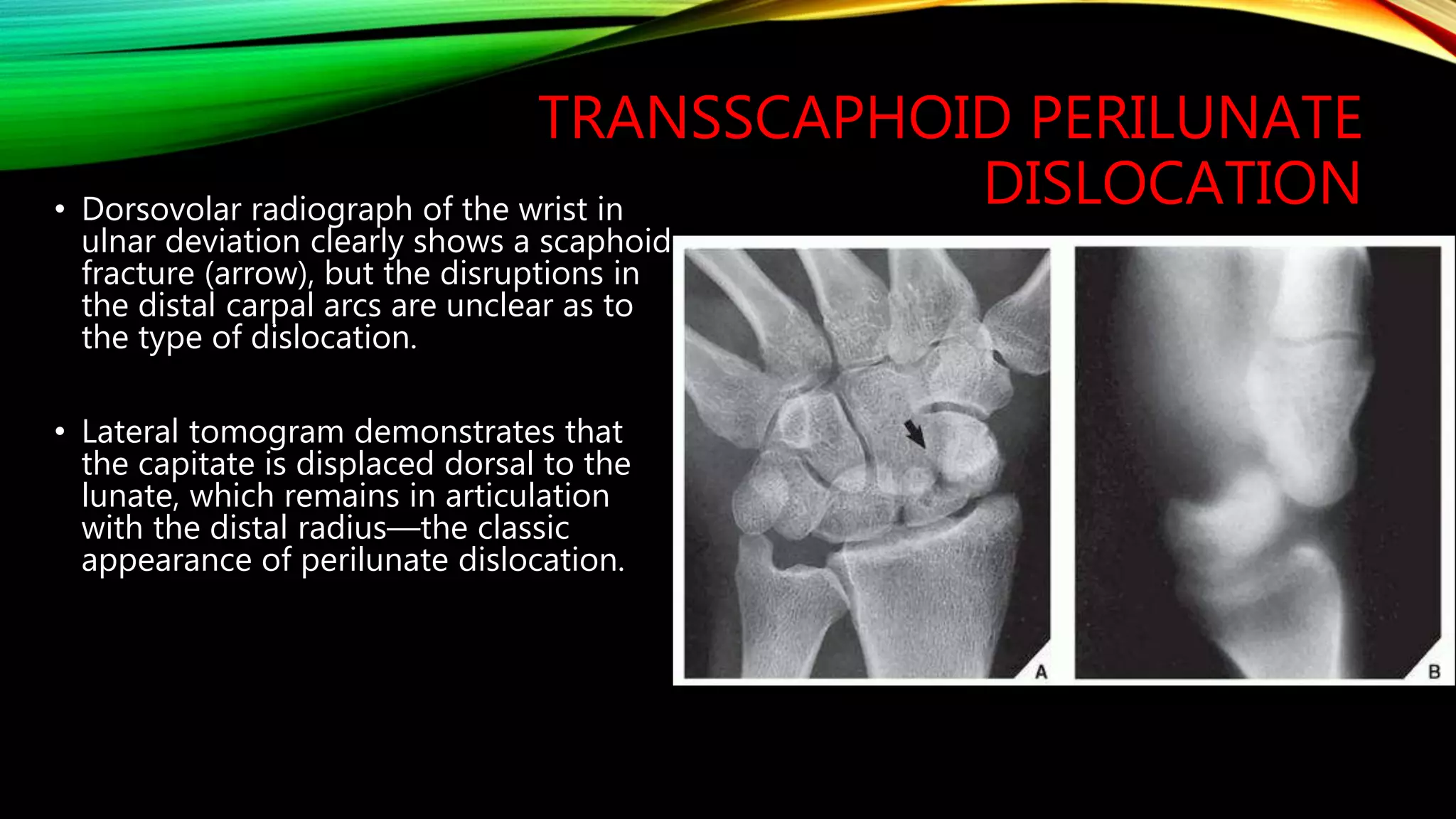 X ray of wrist and hand | PPTX