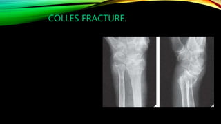 X ray of wrist and hand | PPTX