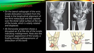 X ray of wrist and hand | PPTX