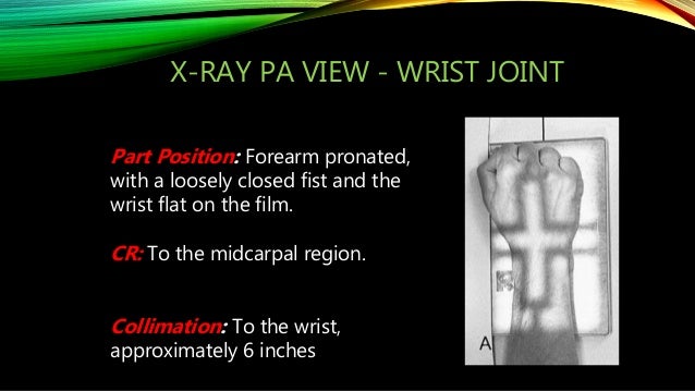 X Ray Of Wrist And Hand