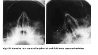 Opacification due to acute maxillary sinusitis and fluid levels seen on tilted view.
 