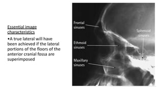 Essential image
characteristics
•A true lateral will have
been achieved if the lateral
portions of the floors of the
anterior cranial fossa are
superimposed
 