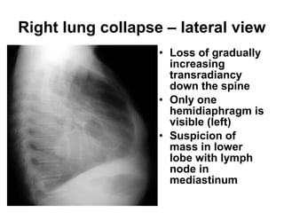 • Loss of gradually
increasing
transradiancy
down the spine
• Only one
hemidiaphragm is
visible (left)
• Suspicion of
mass in lower
lobe with lymph
node in
mediastinum
Right lung collapse – lateral view
 