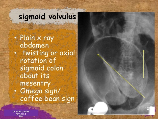X rays
Volvulus X Ray Omega Sign