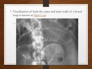 • Visualization of both the outer and inner walls of a bowel
loop is known as Rigler's sign
 