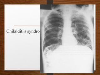 Chilaiditi's syndrome
 
