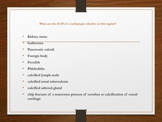 What are the D/D of a radiopaque shadow in this region?
• Kidney stone
• Gallstones
• Pancreatic calculi
• Foreign body
• Fecolith
• Phleboliths
• calcified lymph node
• calcified renal tuberculosis
• calcified adrenal gland
• chip fracture of a transverse process of vertebra or calcification of costal
cartilage
 