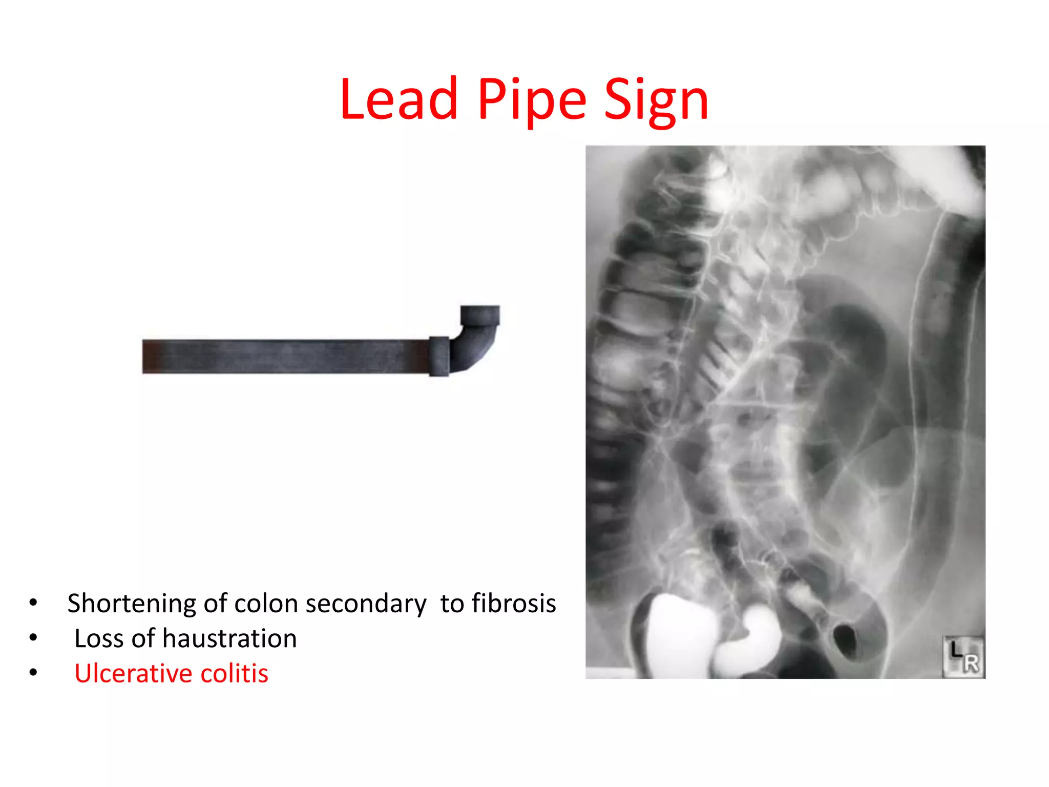 X ray signs of abdomen | PPTX