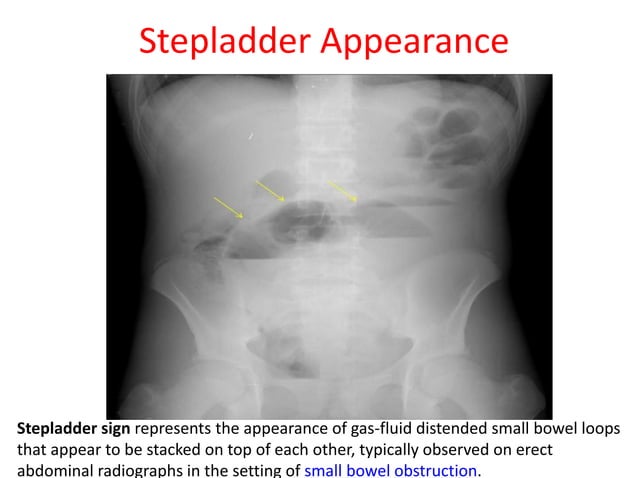 X ray signs of abdomen | PPTX | Digestive Disorders | Diseases and ...