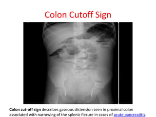 X ray signs of abdomen