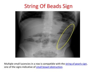 String Sign Crohns Disease