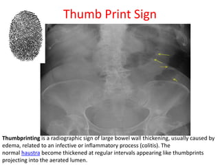 Thumbprint Sign Bowel