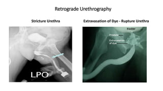 Retrograde Urethrogram Rupture X rays in surgery for undergraduates Dr Dev Taneja-06.06.2021