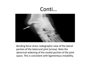 Conti…
Bending force stress radiographic view of the lateral
portion of the talocrural joint (arrow). Note the
abnormal widening of the medial portion of the joint
space. This is consistent with ligamentous instability.
 