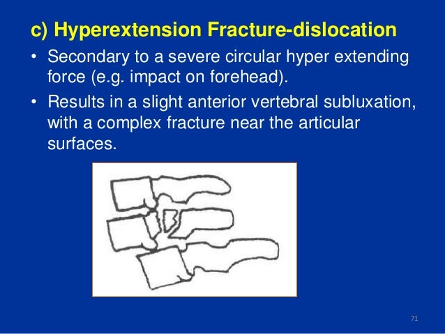 X-ray spine diagram of vertebral fracture 