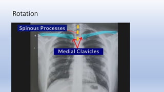 Patient Rotation Cxr Example X- raysss-1.pptx updated 3rd year mbbs students | PPTX