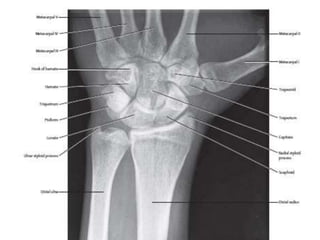 X ray upper limb | PPT