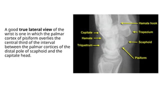 Comprehensive Guide to Reading Wrist X-Rays: Anatomy, Views, and ...