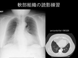 肺門の読影練習
肺小細胞癌の化学療法著効例 A-P windowを見て
 