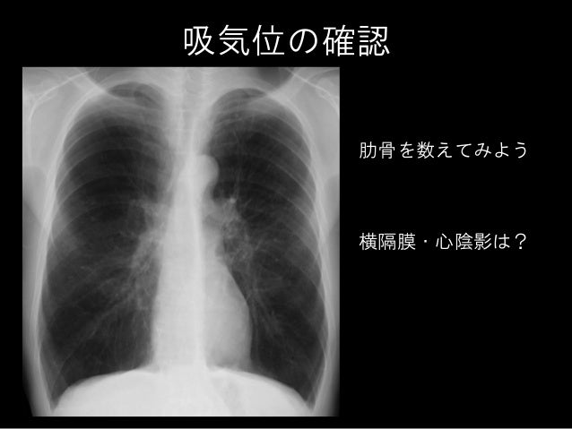 胸部x線写真の診かた