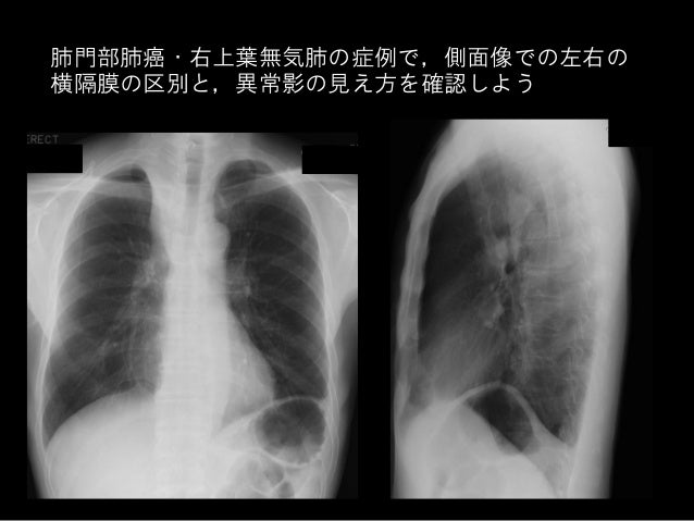 胸部x線写真の診かた