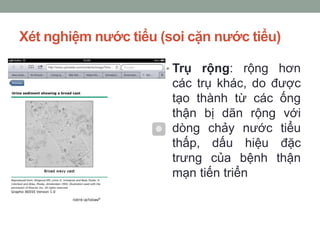 Xét nghiệm nước tiểu (soi cặn nước tiểu)
• Trụ rộng: rộng hơn
các trụ khác, do được
tạo thành từ các ống
thận bị dãn rộng với
dòng chảy nước tiểu
thấp, dấu hiệu đặc
trưng của bệnh thận
mạn tiến triển
 
