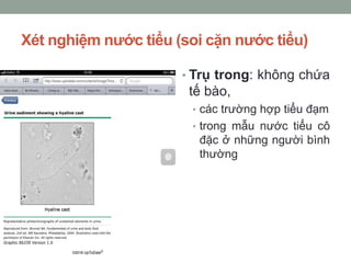 Xét nghiệm nước tiểu (soi cặn nước tiểu)
• Trụ trong: không chứa
tế bào,
• các trường hợp tiểu đạm
• trong mẫu nước tiểu cô
đặc ở những người bình
thường
 