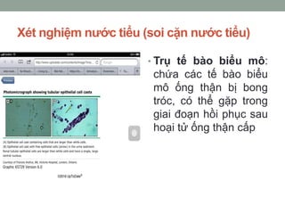 Xét nghiệm nước tiểu (soi cặn nước tiểu)
• Trụ tế bào biểu mô:
chứa các tế bào biểu
mô ống thận bị bong
tróc, có thể gặp trong
giai đoạn hồi phục sau
hoại tử ống thận cấp
 