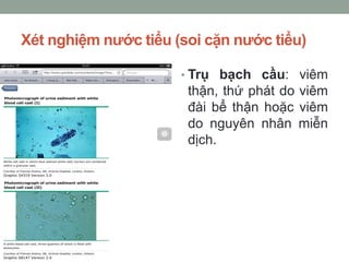 Xét nghiệm nước tiểu (soi cặn nước tiểu)
• Trụ bạch cầu: viêm
thận, thứ phát do viêm
đài bể thận hoặc viêm
do nguyên nhân miễn
dịch.
 