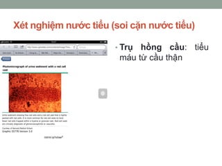Xét nghiệm nước tiểu (soi cặn nước tiểu)
• Trụ hồng cầu: tiểu
máu từ cầu thận
 
