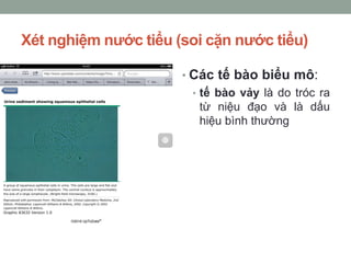 Xét nghiệm nước tiểu (soi cặn nước tiểu)
• Các tế bào biểu mô:
• tế bào vảy là do tróc ra
từ niệu đạo và là dấu
hiệu bình thường
 