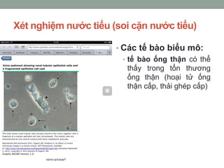 Xét nghiệm nước tiểu (soi cặn nước tiểu)
• Các tế bào biểu mô:
• tế bào ống thận có thể
thấy trong tổn thương
ống thận (hoại tử ống
thận cấp, thải ghép cấp)
 