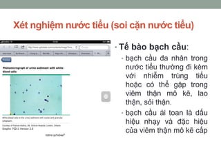 Xét nghiệm nước tiểu (soi cặn nước tiểu)
• Tế bào bạch cầu:
• bạch cầu đa nhân trong
nước tiểu thường đi kèm
với nhiễm trùng tiểu
hoặc có thể gặp trong
viêm thận mô kẽ, lao
thận, sỏi thận.
• bạch cầu ái toan là dấu
hiệu nhạy và đặc hiệu
của viêm thận mô kẽ cấp
 