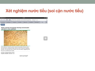 Xét nghiệm nước tiểu (soi cặn nước tiểu)
 