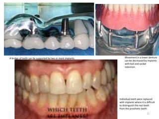 A bridge of teeth can be supported by two or more implants.
Individual teeth were replaced
with implants where it is difficult
to distinguish the real teeth
from the prosthetic teeth.
Movement in a lower denture
can be decreased by implants
with ball and socket
retention.
DENTALS IMPLANTS AND BIOMATERIALS
11
 